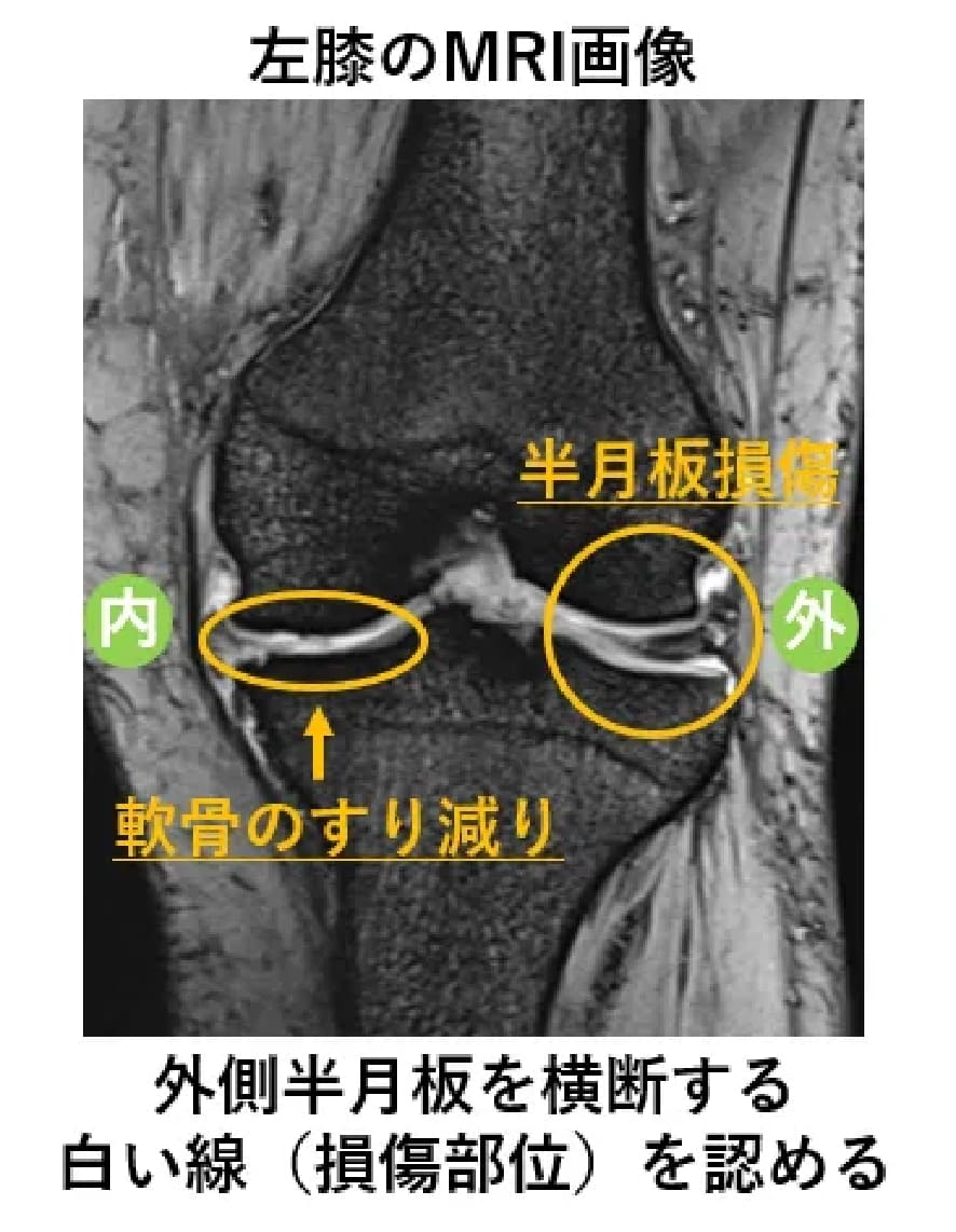 MRI画像